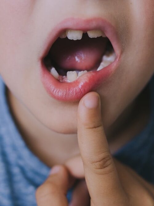 A child points to his mouth due to a tooth injury