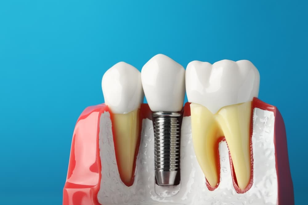 A model of a lower jaw showing a dental implant along with natural teeth on a blue background