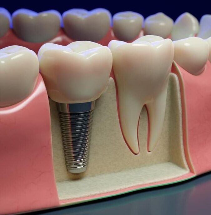 Animation of dental implant up close on molars showing off screw and abutment attaching below gumline.