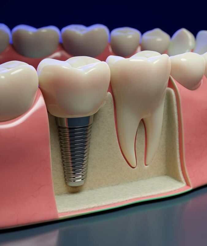 Animation of dental implant up close on molars showing off screw and abutment attaching below gumline.