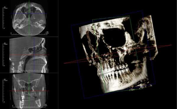 image of a 3d image scan of a skeleton face and tooth