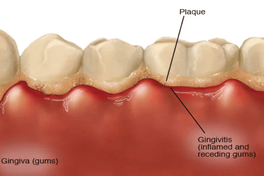 Illustration of signs of Gingivitis