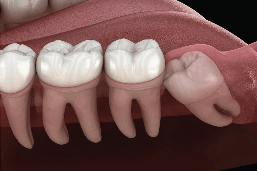 Wisdom Teeth Illustration