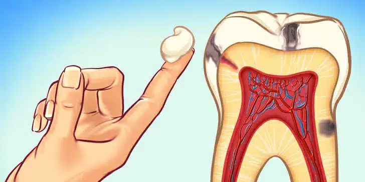 Tooth decay illustration with hand that has numbing ointment on finger